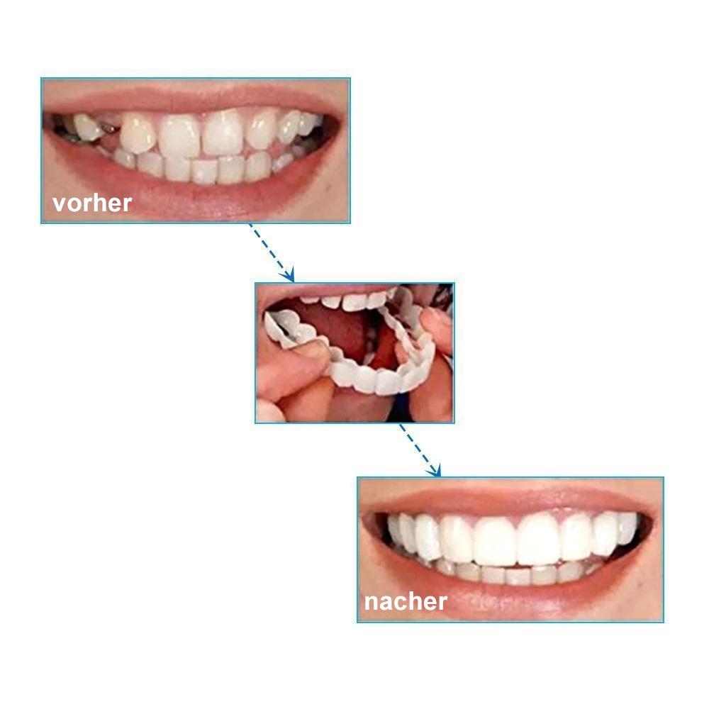 MaxBrace™ - Magische Zahnspange (1+1 GRATIS)