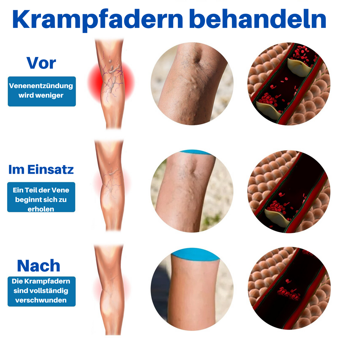 VeinHealer™ - Venenbehandlungsspray (1+1 GRATIS)