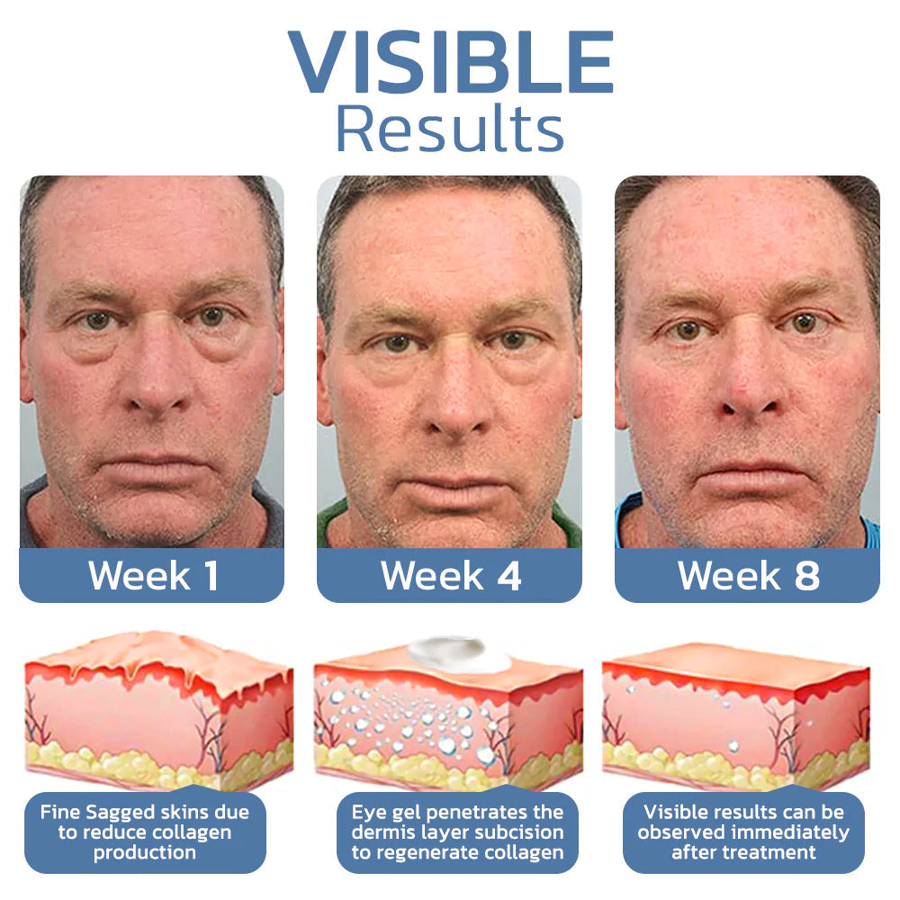 Openeyes™ - Reduziert Schwellungen und Augenringe - 1+1 frei